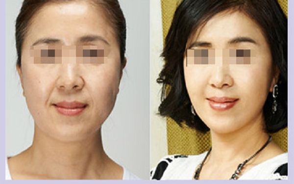 昆明橫向鼻紋整形醫(yī)院推薦榜：實力機(jī)構(gòu)盤點