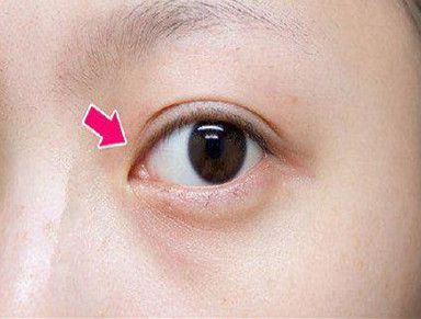 北京眼袋吸脂哪家好？10強(qiáng)醫(yī)院榜單，公立私立齊全！