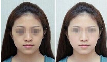 西安肉痣醫(yī)院推薦哪家效果好呢