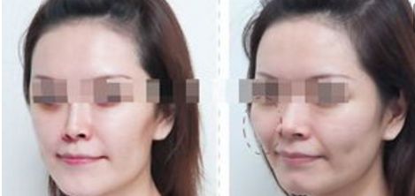 韶關(guān)去上瞼皺紋美容醫(yī)院前十名公開排名