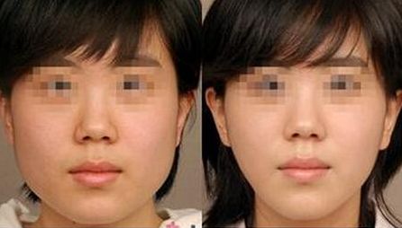 昆明哪家整形醫(yī)院口碑比較好？胸部抽脂術(shù)前10強榜單揭曉！