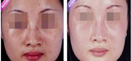 長沙除眼紋醫(yī)院排行榜前十名推薦！