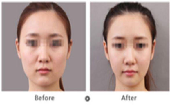 佛山自體脂肪填充修復(fù)痘疤醫(yī)院前十強(qiáng)名單出爐！