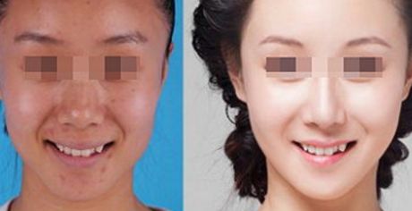 臺州哪家整形醫(yī)院的彩光祛痘效果好？排名前十大口碑整形醫(yī)院推薦