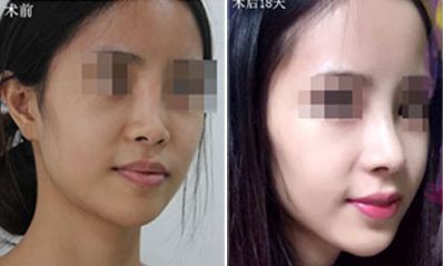 廣州秒雕祛除口周紋醫(yī)療整形醫(yī)院排名公布