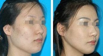 如何選擇適合自己的線雕方案：從20+到40+的不同階段選擇如何根據(jù)不同階段選擇適合自己的線雕方案？