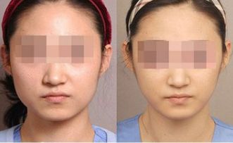 襄陽玻尿酸前額填充整形機構(gòu)十強精選指南