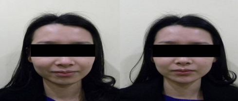 東營(yíng)射頻溶脂瘦后背，哪家醫(yī)院效果好？