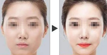 重慶治療痘坑的激光美容醫(yī)院排名前10，技術(shù)一流！