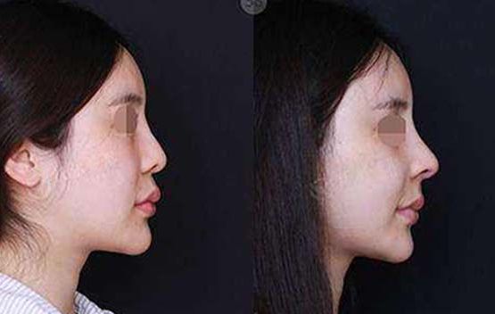 桐廬微針填充醫(yī)院前十推薦：名氣大，效果好，口碑棒