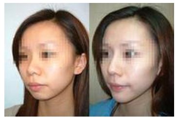 蘭州祛除妊娠紋整形醫(yī)院口碑推薦前10強(qiáng)