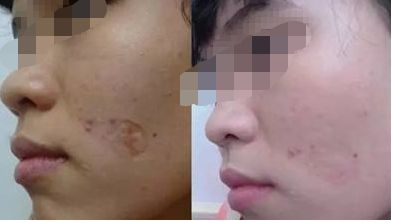 南充值得信賴的無痕雙眼皮醫(yī)院精選榜單，助你桃花眼魅力升級