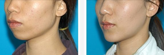 長(zhǎng)沙硅膠植入下巴手術(shù)醫(yī)院排名前十，口碑好評(píng)揭秘！