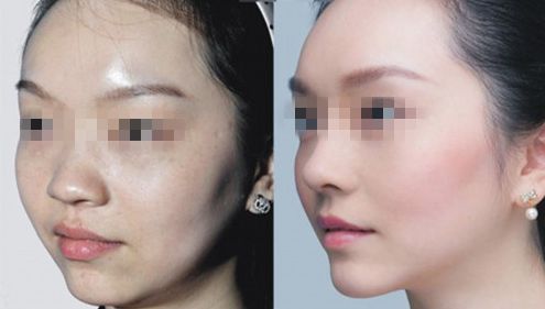 深圳雙眼皮手術(shù)醫(yī)院排名及評(píng)測(cè)2024 前十強(qiáng)醫(yī)院揭曉