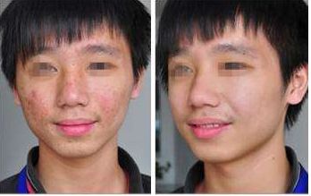 寧波雙眼皮整形醫(yī)院口碑前十精選，助你打造完美眼眸