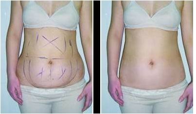 杭州腹部整形醫(yī)院口碑排名前10大揭秘，精準(zhǔn)解讀實(shí)力榜單