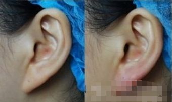 深圳下巴填充膠原蛋白醫(yī)院推薦：前十名不容錯過