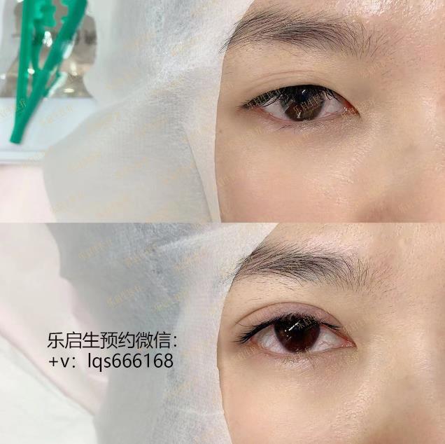 樂啟生周小生醫(yī)生無痕雙眼皮是永久的嗎？會不會變成內(nèi)雙呢？