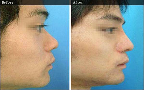 2023寧波唇紋自體脂肪填充醫(yī)生排名名單一覽！楊勇、吳天斌、許素玲當?shù)刂臒衢T醫(yī)生