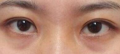 2023西安顴骨墊高手術醫(yī)生排名榜前10已出爐！梁志偉、吳剛、陳漢杰專家實力細數、價格公布