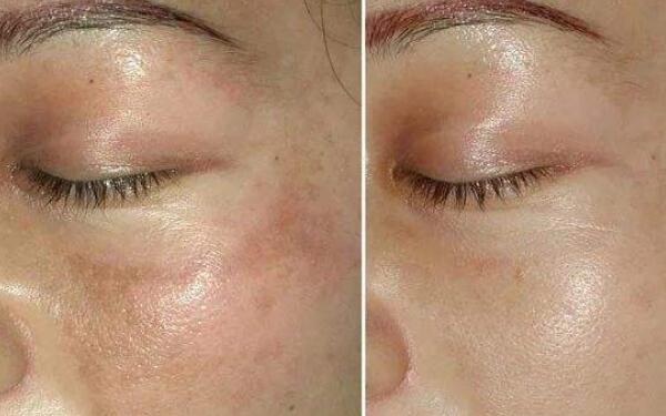 2023阜陽打玻尿酸隆鼻評分TOP10強醫(yī)生擅長點評！沈炳家、沈正洲、張學飛這些醫(yī)生你知道嗎？