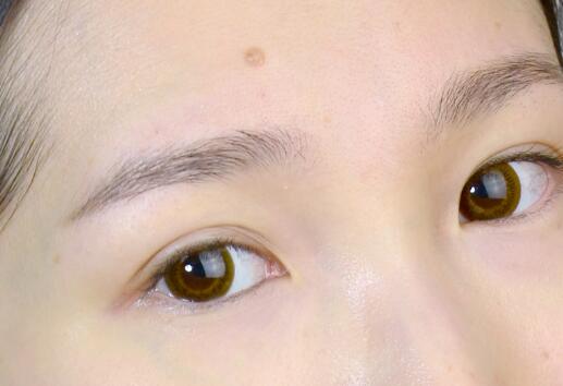 秦皇島水光針去黑眼圈醫(yī)生