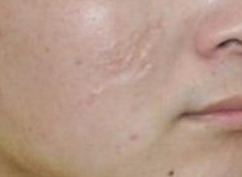 2023眉山面部激光除皺在榜單top10專家終于發(fā)了！李建剛、龔恩進(jìn)、曾藍(lán)瑤匯集超人氣實(shí)力三甲專家