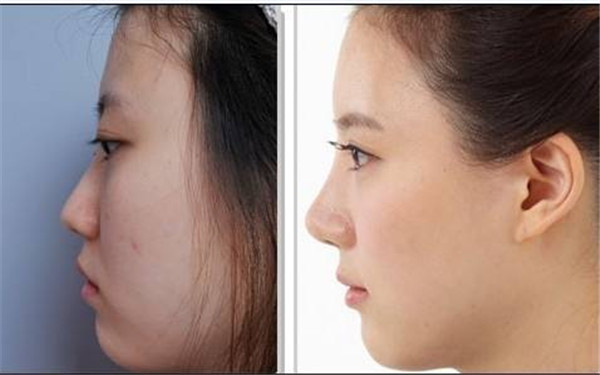 2023西安假性眼袋吸脂專家在榜清單前10名公立還是私立？高彩茹、張春紅、雒崇義專業(yè)專家任您挑選