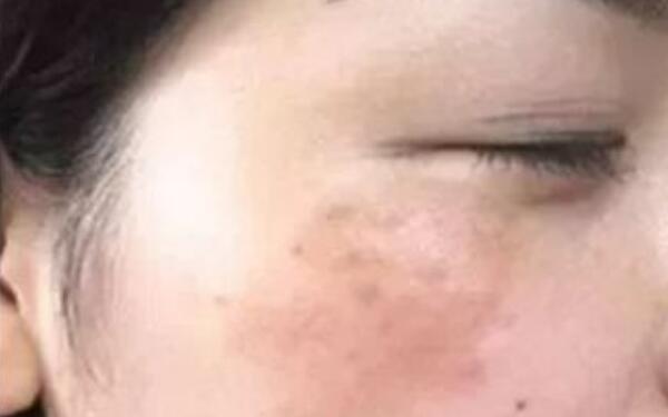 2023大連超聲刀祛老年斑前10醫(yī)生強榜分享~秦宏智、胡剛、韓忠熙權(quán)威推薦