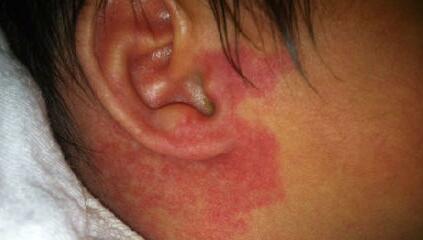 2023重慶下巴凹陷疤痕微針權(quán)威專家榜單前10強閉眼可入！楊登齊、翁瑞全、張敏珠也參與其中