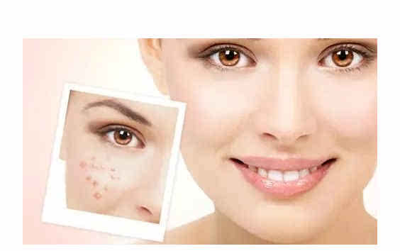 淄博激光去色素斑價格