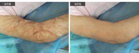 上海背部脫毛費用多少錢呢(上海美道醫(yī)療美容背部脫毛參考價：3720元)