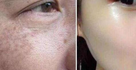 杭州水光針去除妊娠紋價(jià)格