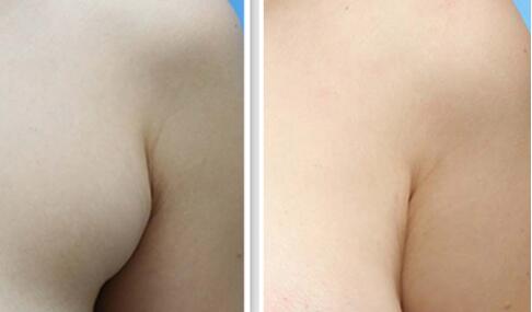 深圳光雕溶脂瘦腰價(jià)格如何確定呢(深圳歐亞美創(chuàng)醫(yī)療美容診所光雕溶脂瘦腰參考價(jià)：4502元)