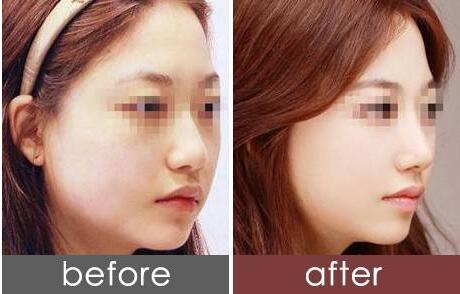 杭州V8動感美胸價格