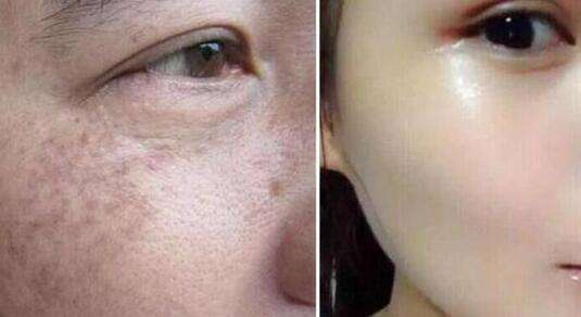 西安生長紋填充脂肪2023收費標(biāo)準詳細展示(西安邵醫(yī)生整形美容中心生長紋填充脂肪參考價：4305元)