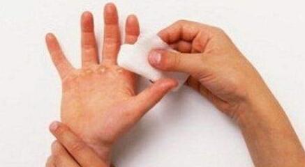 遵義凹陷疤痕激光祛疤手術(shù)費(fèi)用明細(xì)查詢(遵義中醫(yī)院皮膚科凹陷疤痕激光祛疤參考價(jià)：3502元)