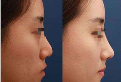 四川黃金微雕去眼周紋價格