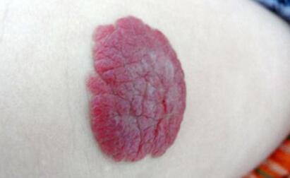 萍鄉(xiāng)微晶磨削祛斑價目表放出(萍鄉(xiāng)第二人民醫(yī)院整形外科微晶磨削祛斑參考價：5011元)