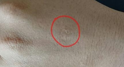 福州男性乳房肥大矯正大概需要手術(shù)價格多少(福州海西迪婭醫(yī)療美容整形醫(yī)院男性乳房肥大矯正參考價：6393元)