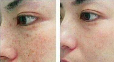 無錫痘坑激光治療價(jià)格