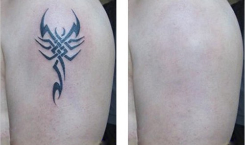 上海硅膠乳房再造收費(fèi)標(biāo)準(zhǔn)圖表參考(2023上海硅膠乳房再造參考價(jià)為：6362元)