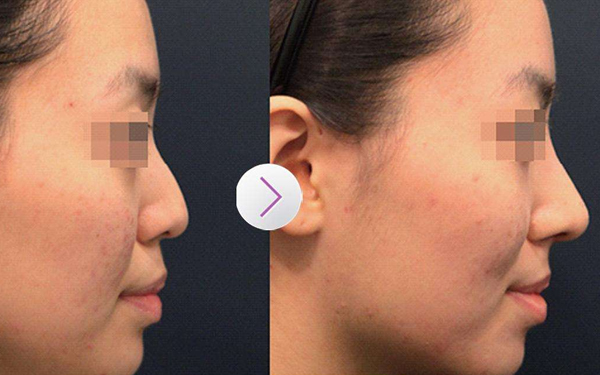 四川e光美白嫩膚治療價格表呈現(xiàn)(四川米蘭柏羽醫(yī)學(xué)美容醫(yī)院e光美白嫩膚參考價：5060元)