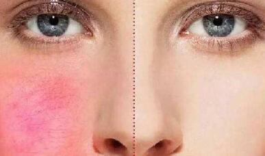 成都自體脂肪填充豐眼窩治療價目表公示(2023成都自體脂肪填充豐眼窩參考價為：6688元)