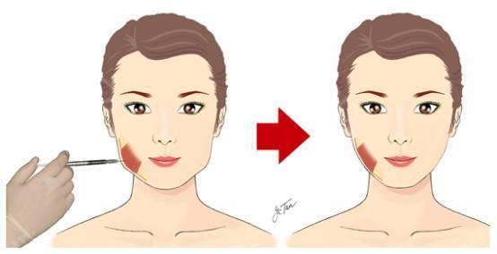 青島眼部細紋注射玻尿酸收費明細更新發(fā)布(2023青島眼部細紋注射玻尿酸參考價為：6355元)
