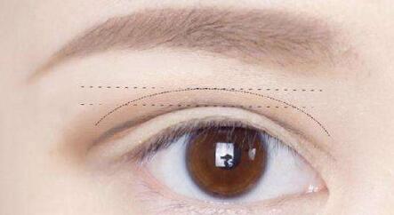 北京小切口眼部除皺術(shù)價(jià)位表一覽(2023北京小切口眼部除皺術(shù)參考價(jià)為：6471元)