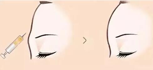 合肥膨體隆下巴收費(fèi)標(biāo)準(zhǔn)2023預(yù)先一覽(2023合肥膨體隆下巴參考價(jià)為：5926元)