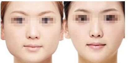 長沙開合鼻修復(fù)手術(shù)多少錢(2023長沙開合鼻修復(fù)參考價(jià)為：6512元)