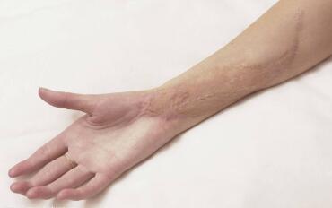 蘇州內(nèi)切除眼袋價(jià)格