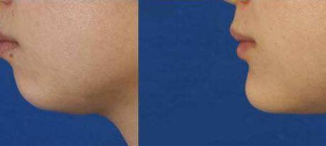 常德秒雕去法令紋手術(shù)價格匯總(2023常德秒雕去法令紋參考價為：6256元)